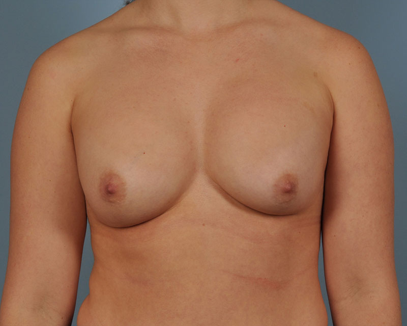 Breast Revision Before and After | Dr. Thomas Hubbard