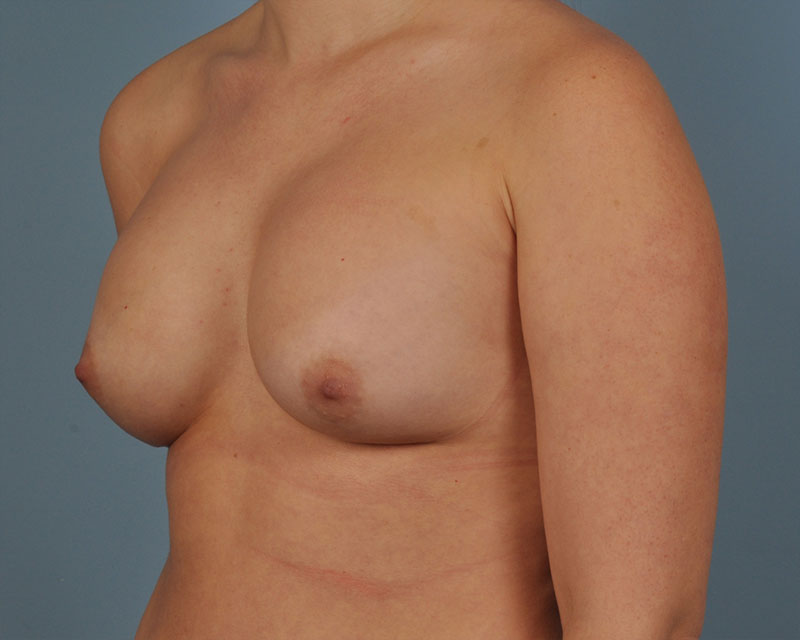 Breast Revision Before and After | Dr. Thomas Hubbard