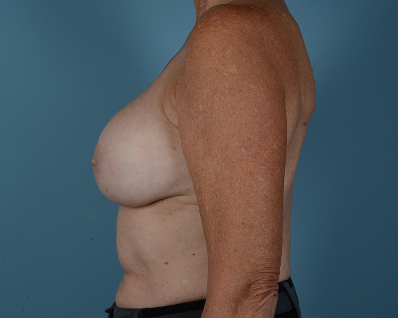 Breast Revision Before and After | Dr. Thomas Hubbard