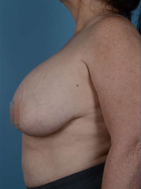 Breast Revision Before and After | Dr. Thomas Hubbard