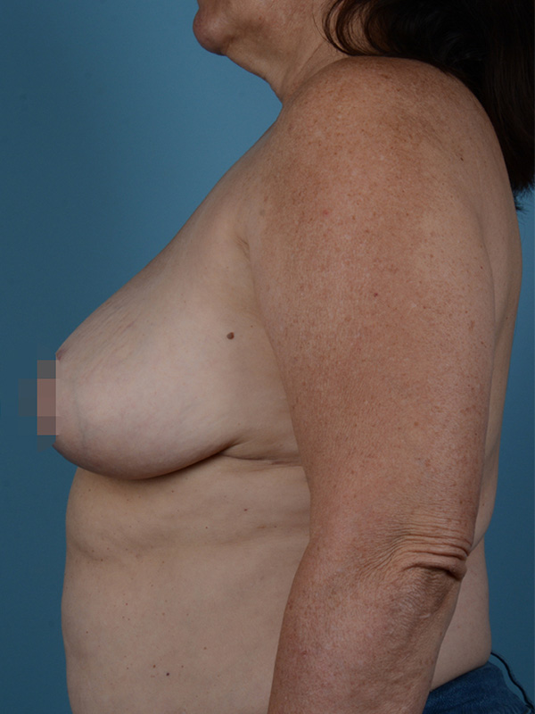 Breast Revision Before and After | Dr. Thomas Hubbard