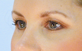 Brow Lift Before and After | Dr. Thomas Hubbard