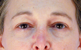 Brow Lift Before and After | Dr. Thomas Hubbard