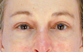 Brow Lift Before and After | Dr. Thomas Hubbard