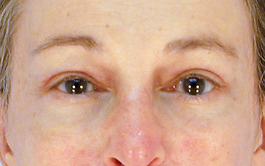 Brow Lift Before and After | Dr. Thomas Hubbard