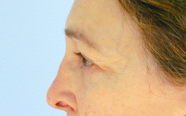 Brow Lift Before and After | Dr. Thomas Hubbard