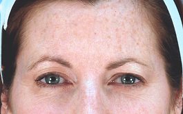 Brow Lift Before and After | Dr. Thomas Hubbard