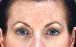 Brow Lift Before and After | Dr. Thomas Hubbard