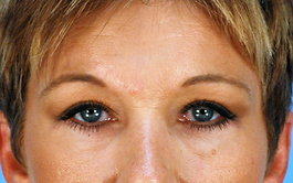 Brow Lift Before and After | Dr. Thomas Hubbard