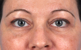 Brow Lift Before and After | Dr. Thomas Hubbard