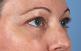 Brow Lift Before and After | Dr. Thomas Hubbard