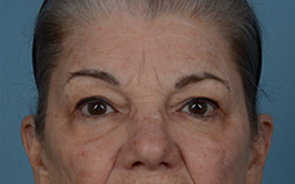 Brow Lift Before and After | Dr. Thomas Hubbard