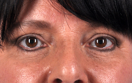 Eyelid Surgery Before and After | Dr. Thomas Hubbard