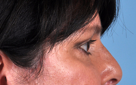 Eyelid Surgery Before and After | Dr. Thomas Hubbard