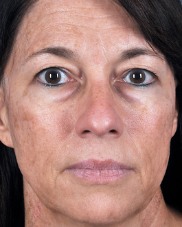 Eyelid Surgery Before and After | Dr. Thomas Hubbard