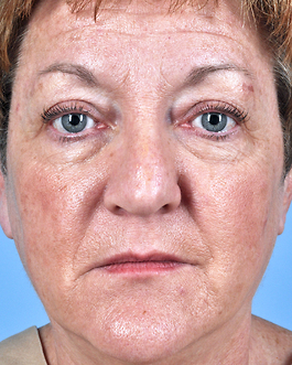 Eyelid Surgery Before and After | Dr. Thomas Hubbard