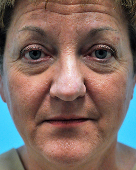 Eyelid Surgery Before and After | Dr. Thomas Hubbard
