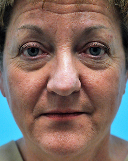 Eyelid Surgery Before and After | Dr. Thomas Hubbard