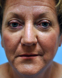 Eyelid Surgery Before and After | Dr. Thomas Hubbard