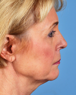 Eyelid Surgery Before and After | Dr. Thomas Hubbard