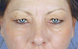 Eyelid Surgery Before and After | Dr. Thomas Hubbard