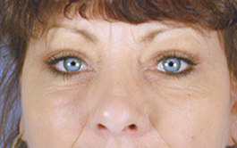 Eyelid Surgery Before and After | Dr. Thomas Hubbard