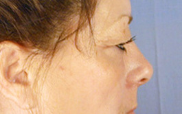 Eyelid Surgery Before and After | Dr. Thomas Hubbard