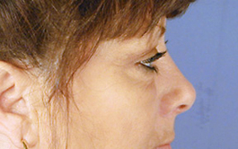 Eyelid Surgery Before and After | Dr. Thomas Hubbard