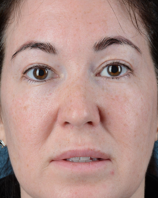 Eyelid Surgery Before and After | Dr. Thomas Hubbard