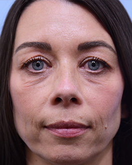 Eyelid Surgery Before and After | Dr. Thomas Hubbard