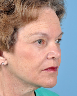 Face Lift Before and After | Dr. Thomas Hubbard