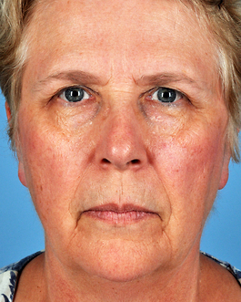 Face Lift Before and After | Dr. Thomas Hubbard