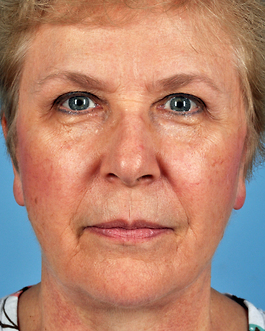 Face Lift Before and After | Dr. Thomas Hubbard