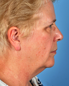 Face Lift Before and After | Dr. Thomas Hubbard