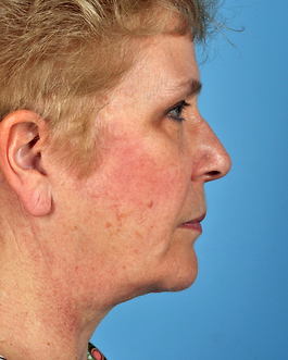 Face Lift Before and After | Dr. Thomas Hubbard