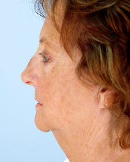 Face Lift Before and After | Dr. Thomas Hubbard