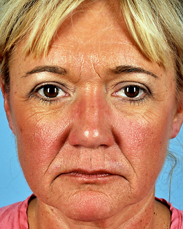 Face Lift Before and After | Dr. Thomas Hubbard