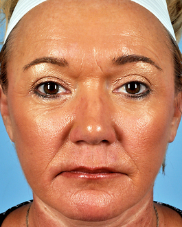 Face Lift Before and After | Dr. Thomas Hubbard