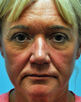 Face Lift Before and After | Dr. Thomas Hubbard