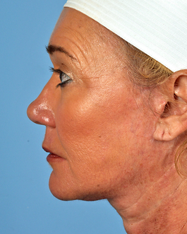 Face Lift Before and After | Dr. Thomas Hubbard