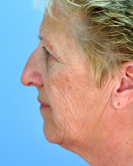 Face Lift Before and After | Dr. Thomas Hubbard