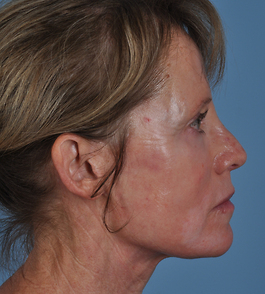 Face Lift Before and After | Dr. Thomas Hubbard