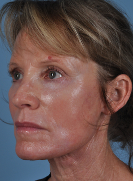 Face Lift Before and After | Dr. Thomas Hubbard