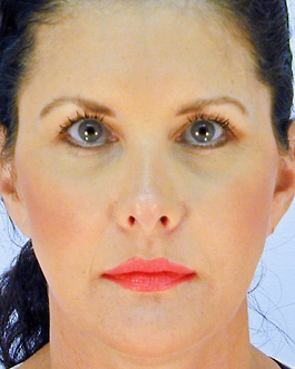 Face Lift Before and After | Dr. Thomas Hubbard