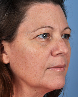 Face Lift Before and After | Dr. Thomas Hubbard