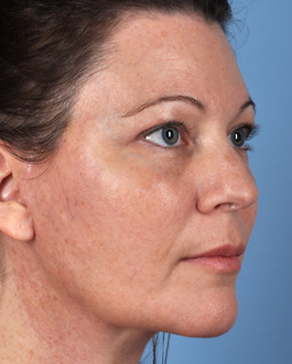 Face Lift Before and After | Dr. Thomas Hubbard