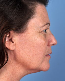 Face Lift Before and After | Dr. Thomas Hubbard