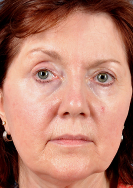 Face Lift Before and After | Dr. Thomas Hubbard