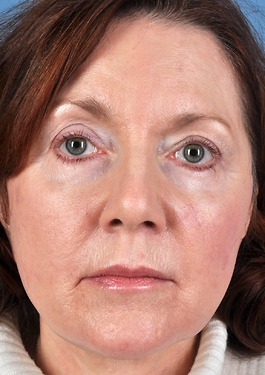 Face Lift Before and After | Dr. Thomas Hubbard