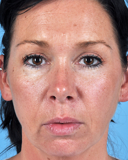 Face Lift Before and After | Dr. Thomas Hubbard